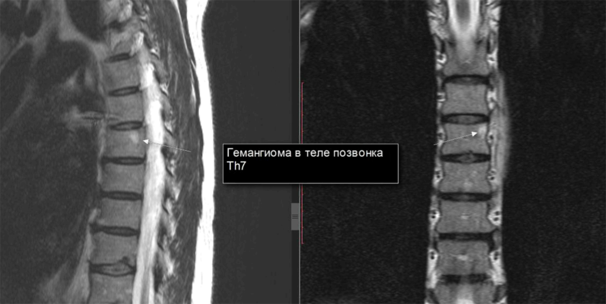 Гемангиома шейного отдела что это. Th1 позвонка гемангиома 10 мм. Гемангиома позвоночника l2. Гемангиома th10 позвонка. Гемангиома l2 позвонка 15 мм.