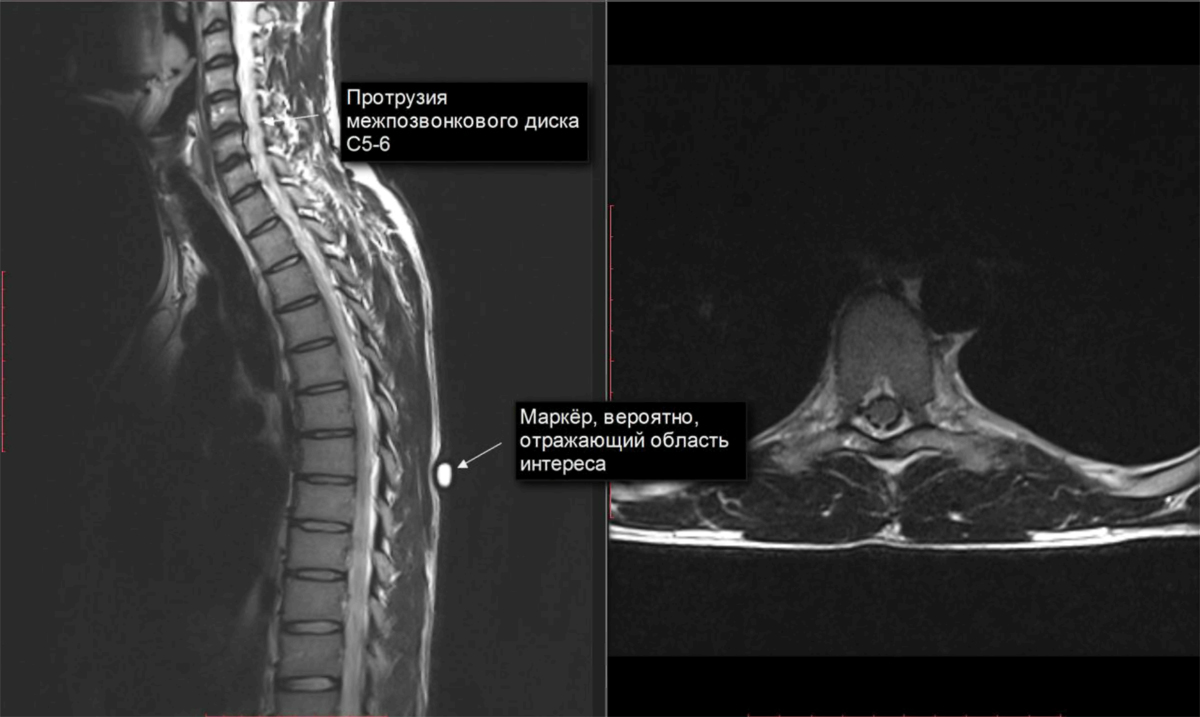 Протрузия дисков позвоночника фото