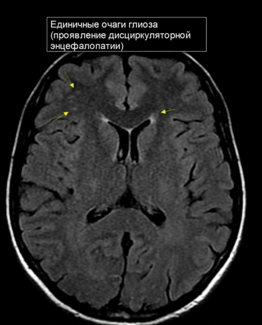 Субкортикальные очаги глиоза в белом веществе