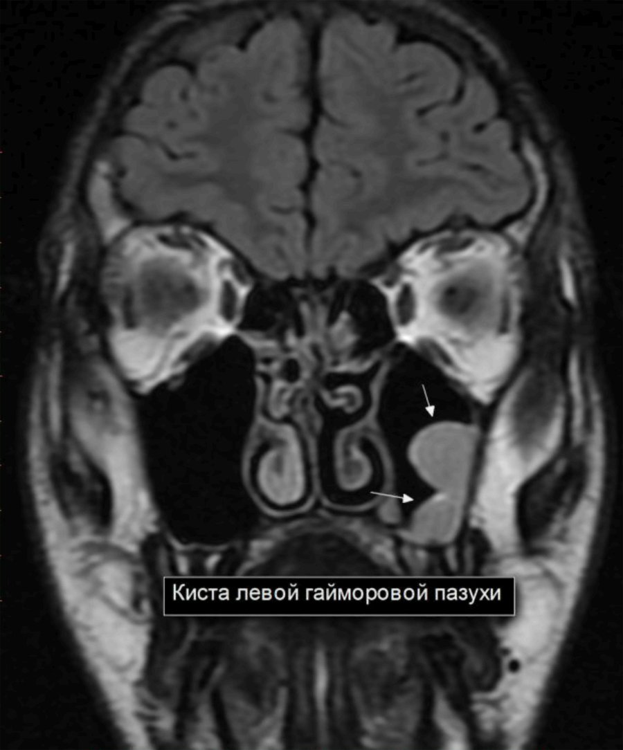 Киста на нижней стенке правой верхнечелюстной пазухи