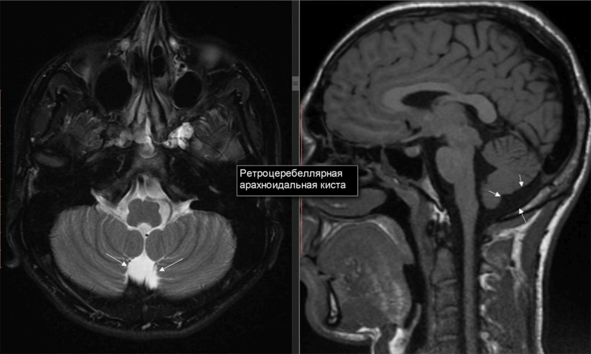 Ретроцеребеллярная арахноидальная ликворная киста …