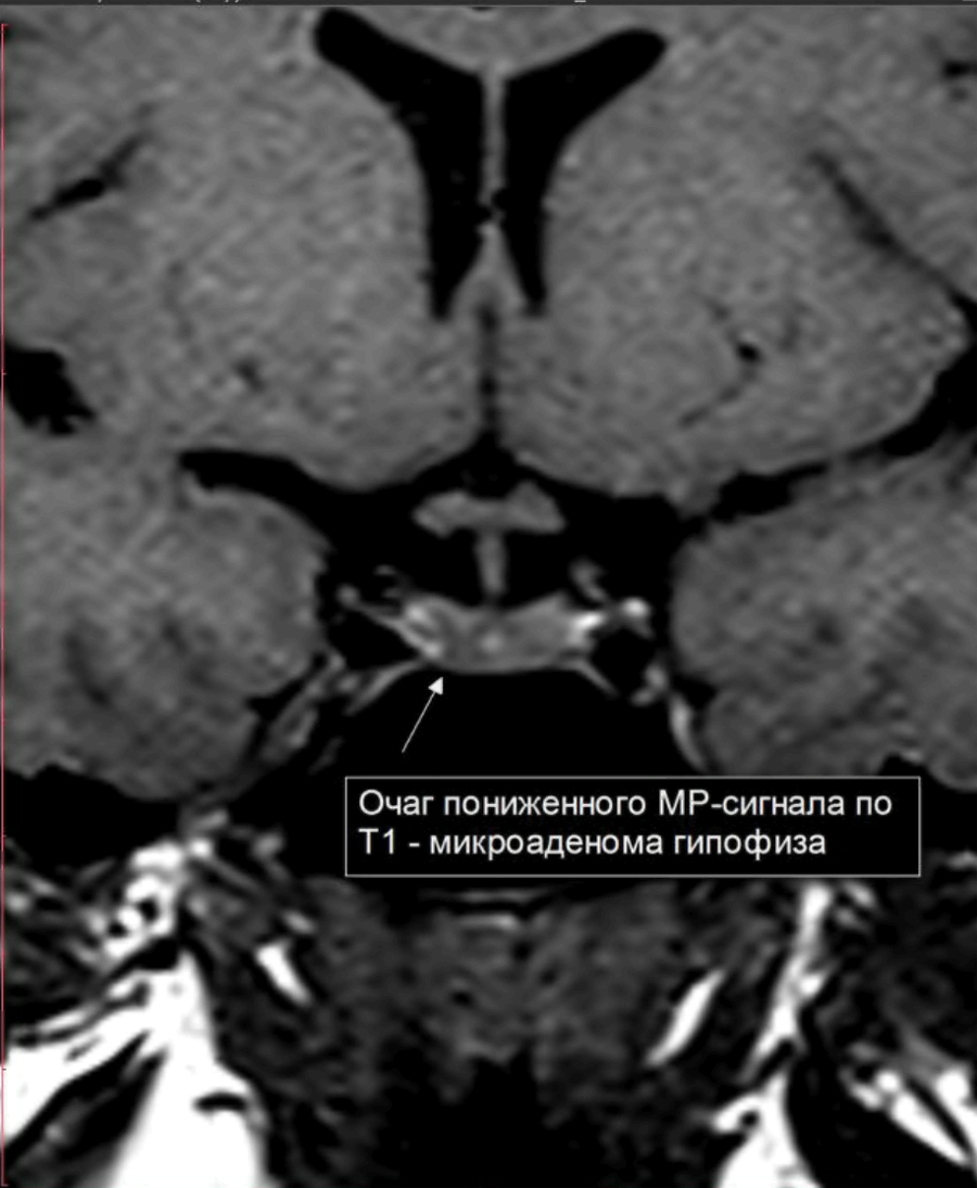 Микроаденома гипофиза МРТ | Второе мнение