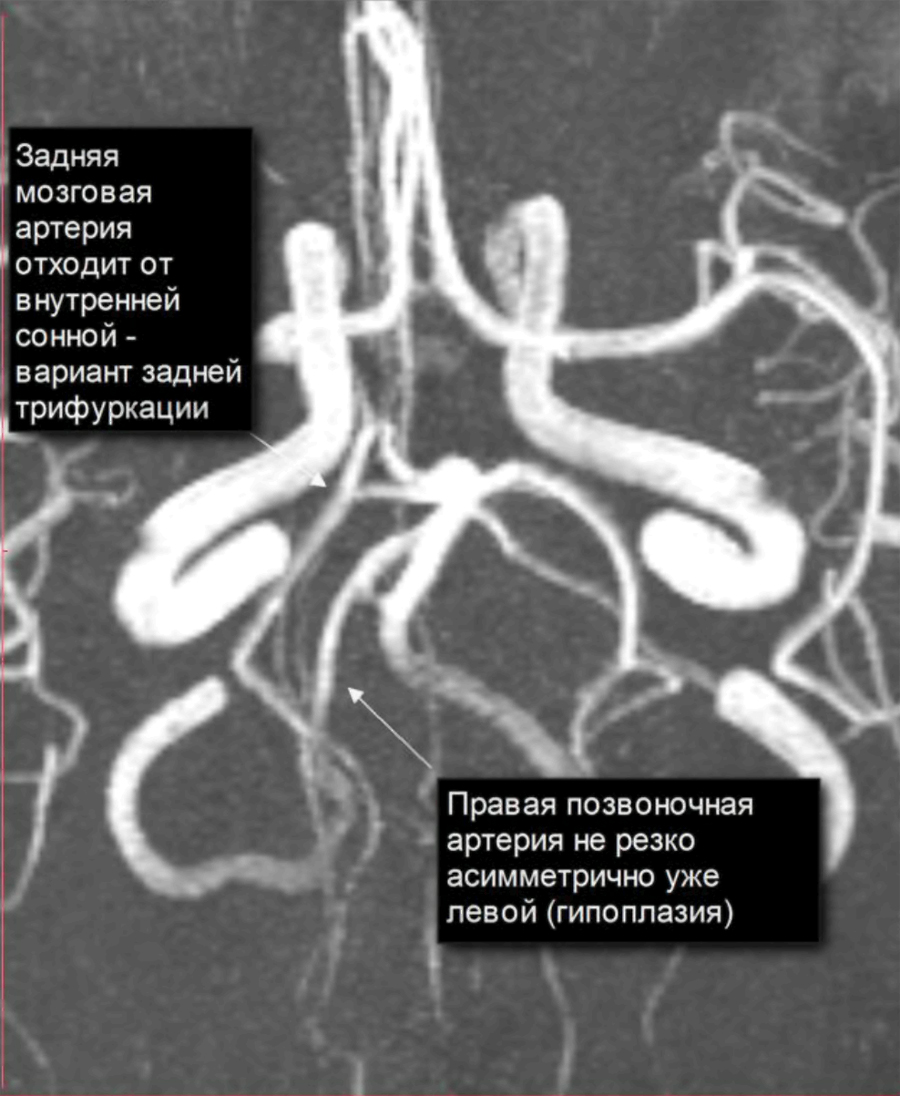 Гипоплазия правой позвоночной артерии опасна. Гипоплазия позвоночной артерии. Задняя трифуркация внутренней сонной артерии мрт. Гипоплазия позвоночной артерии мрт.