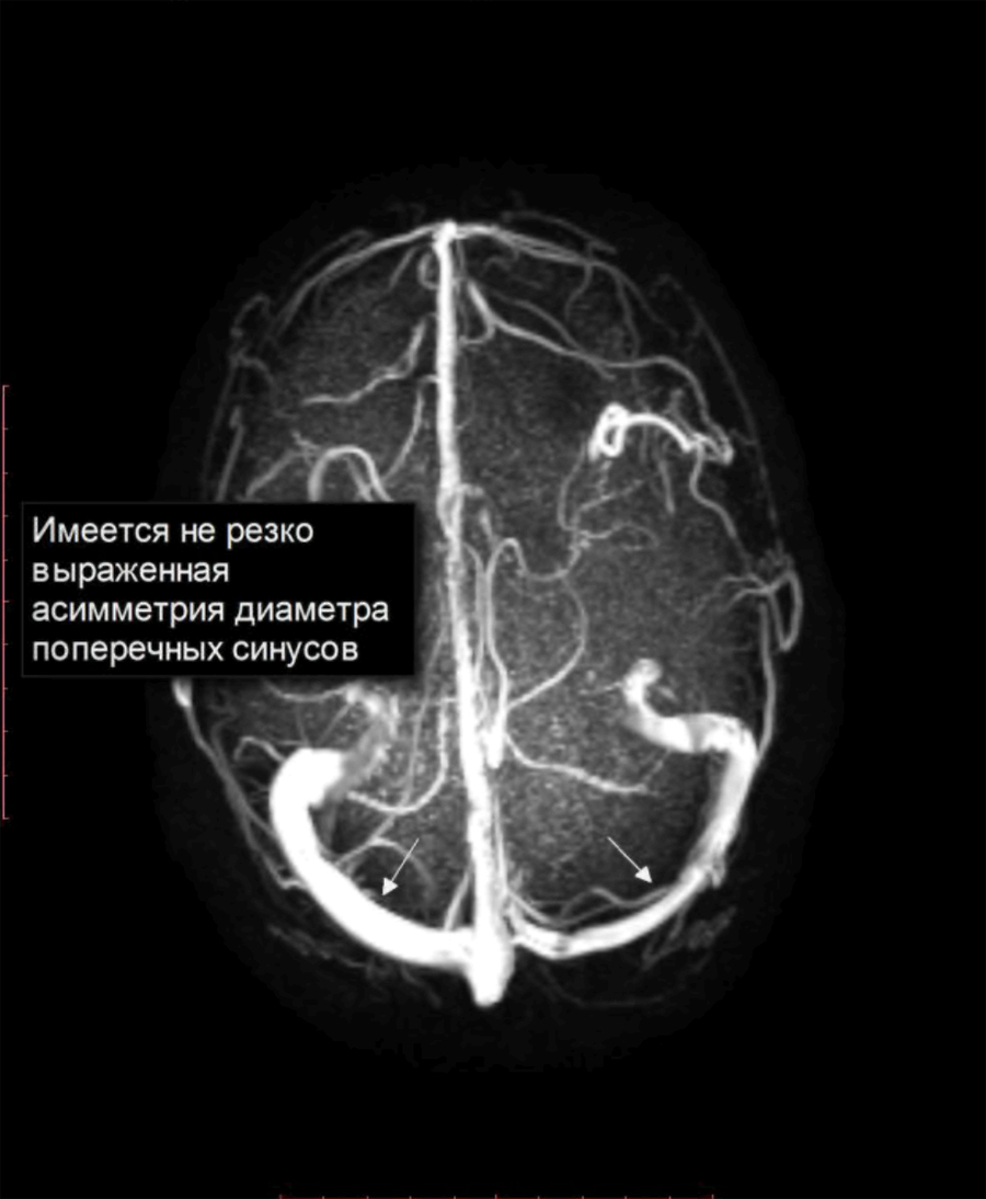 Гипоплазия поперечных синусов головного мозга. Сегменты позвоночной артерии мрт. Гипоплазия позвоночной артерии мрт. Гипоплазия v4 сегмента правой позвоночной артерии. Гипоплазия поперечного синуса мрт.