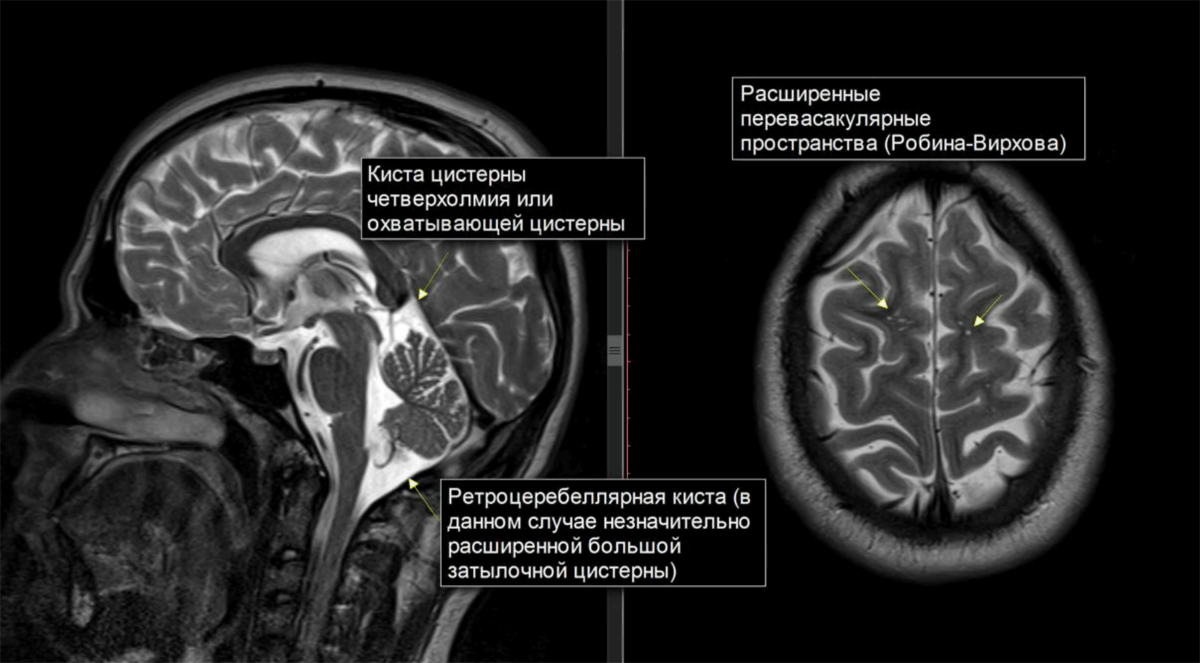 Ликворная киста головного