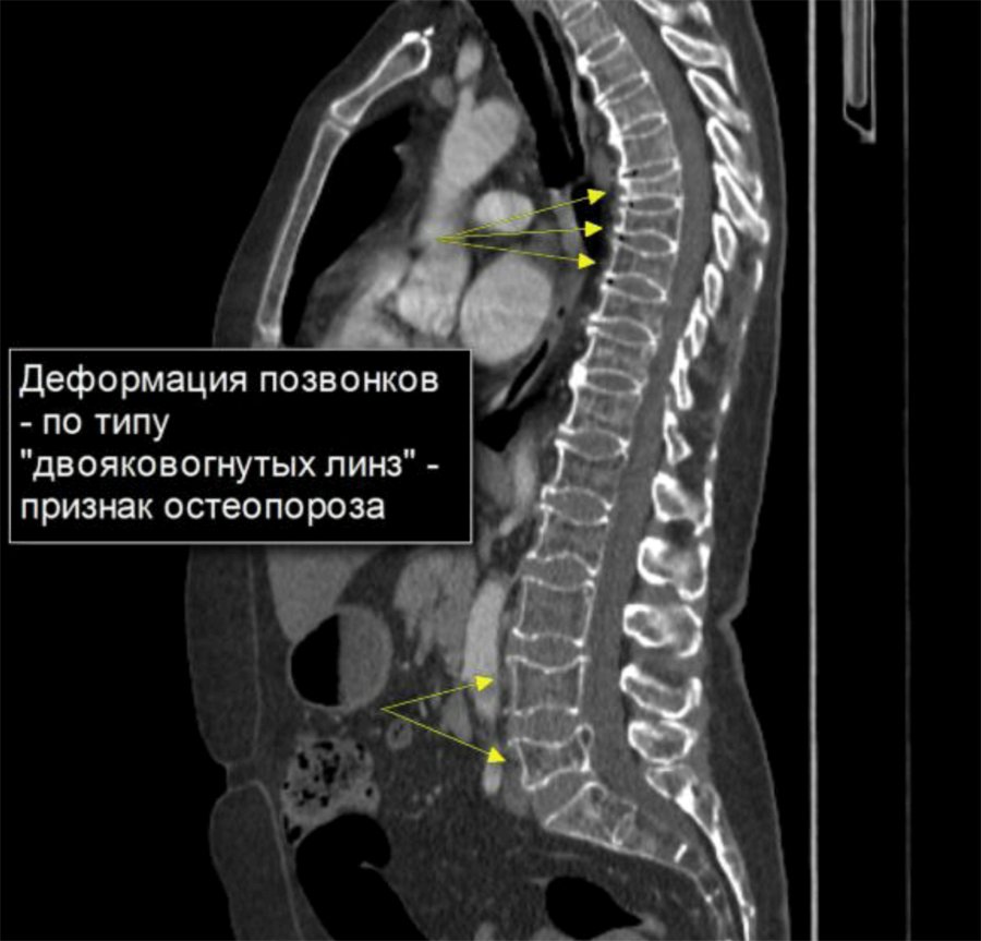 Панкреатит