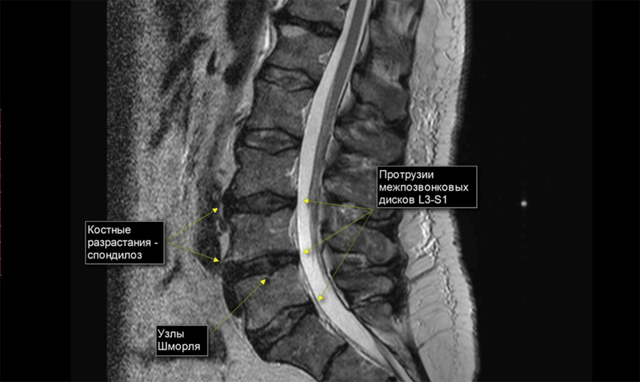 Протрузия что это. Дорзальная протрузия l4/5. Циркулярное выбухание диска l4/l5.. Протрузии дисков l3-l5.