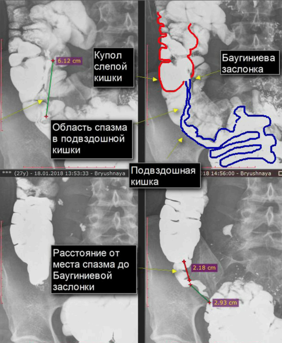 Баугиниевая заслонка кишечника где находится