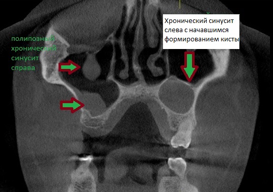 Полипозная дегенерация