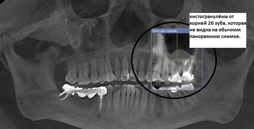 Периостит верхней челюсти фото Картина хронического периодонтита Второе мнение