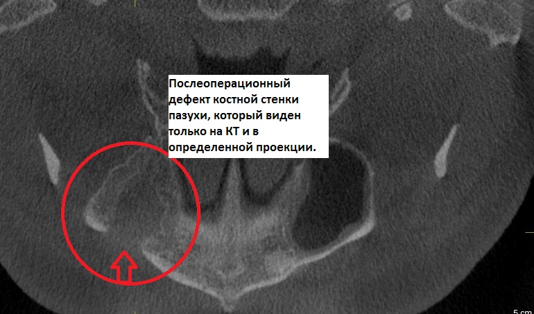 Перелом верхней стенки верхнечелюстной пазухи