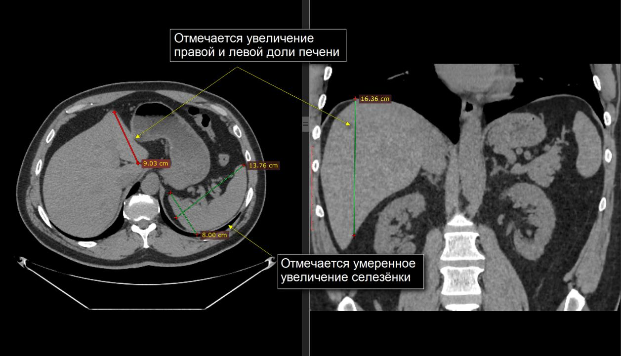 Размеры печени на кт норма. Мальформация в печени кт. Измерение печени на кт.