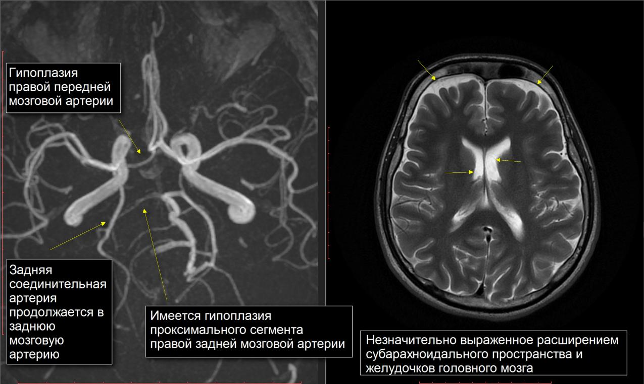 Гипоплазия левой позвоночной артерии симптомы. Гипоплазия р1 сегмента мозговой артерии. Гипоплазия сосудов головного мозга. Гипоплазия задней мозговой артерии р1 сегмента. Гипоплазия р1 сегмента левой задней мозговой артерии.