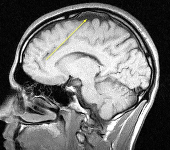 Расширение субарахноидальных щелей. Арахноидальная ликворная киста мрт. Расширение субарахноидального пространства на мрт. Арахноидальная киста гипофиза мрт. Конвекситальная арахноидальная ликворная киста мрт.