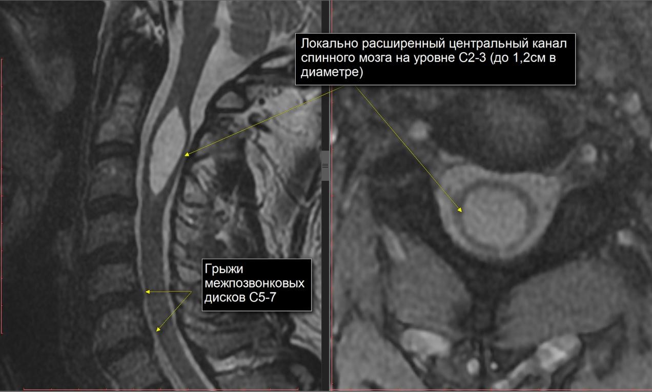 Спайки поясницы. Гидросирингомиелия мрт. Расширение центрального спинномозгового канала мрт. Локальное расширение центрального канала спинного мозга. Мрт спинного мозга.
