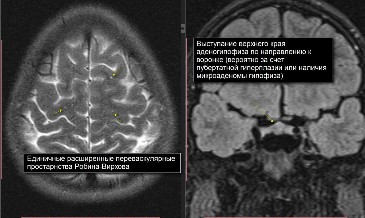 Пространства вирхова робина что это значит. Пространства Вирхова-Робина расширены. Расширенные пространства Вирхова-Робина на кт. Расширение периваскулярных пространств мрт. Периваскулярные пространства Вирхова-Робина мрт головного мозга.