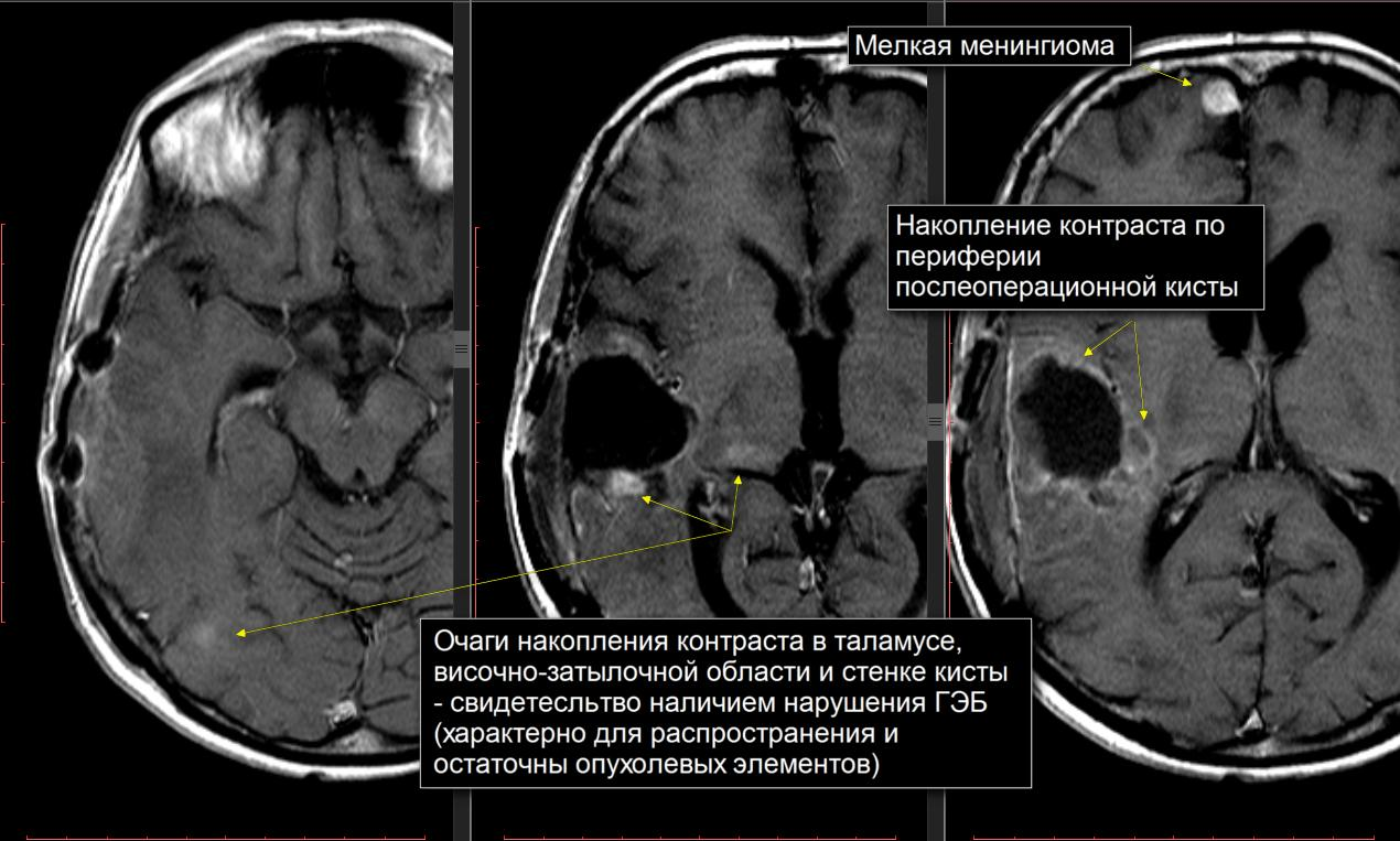 Кисты головного мозга — ФЕДЕРАЛЬНЫЙ ЦЕНТР НЕЙРОХИРУРГИИ