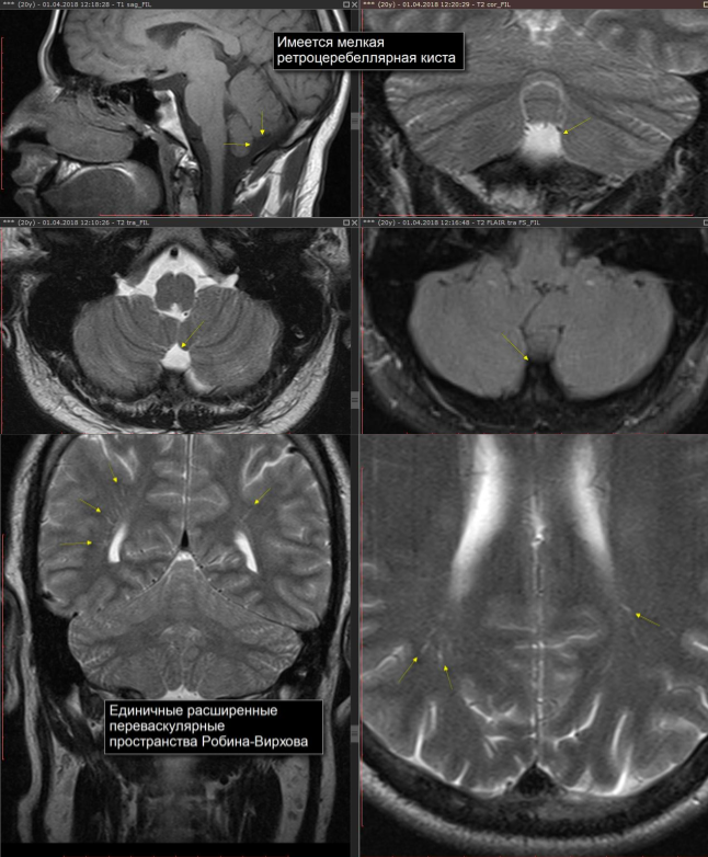 Ретроцеребеллярная киста мрт. Ретроцеребеллярная киста на кт. Ретроцеребеллярная киста в головном мозге кт. Ретроцеребеллярная арахноидальная киста кт. Ретроцеребеллярная цистерна кт.