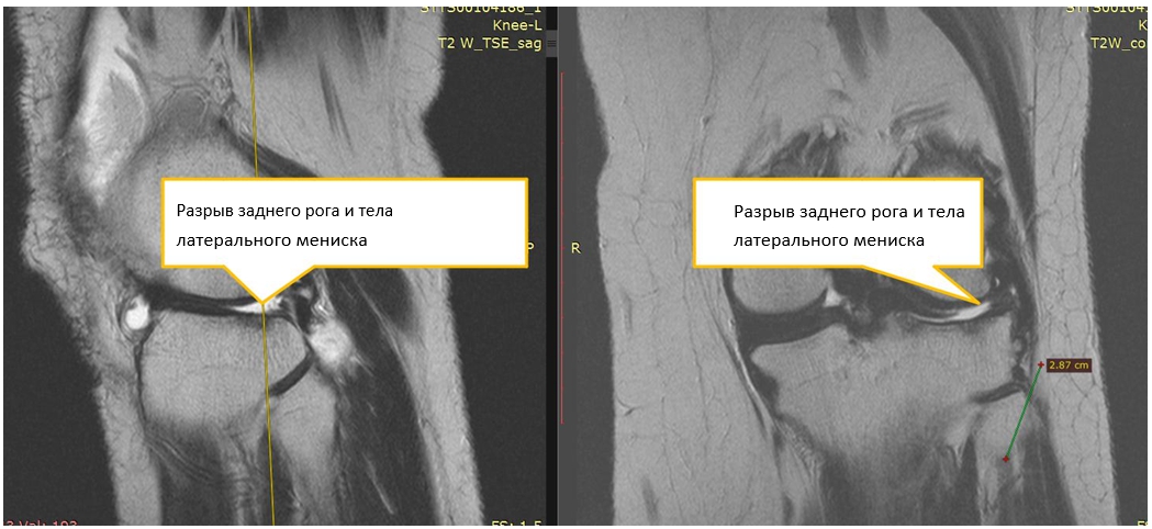 Отек костного мозга медиального мыщелка большеберцовой кости