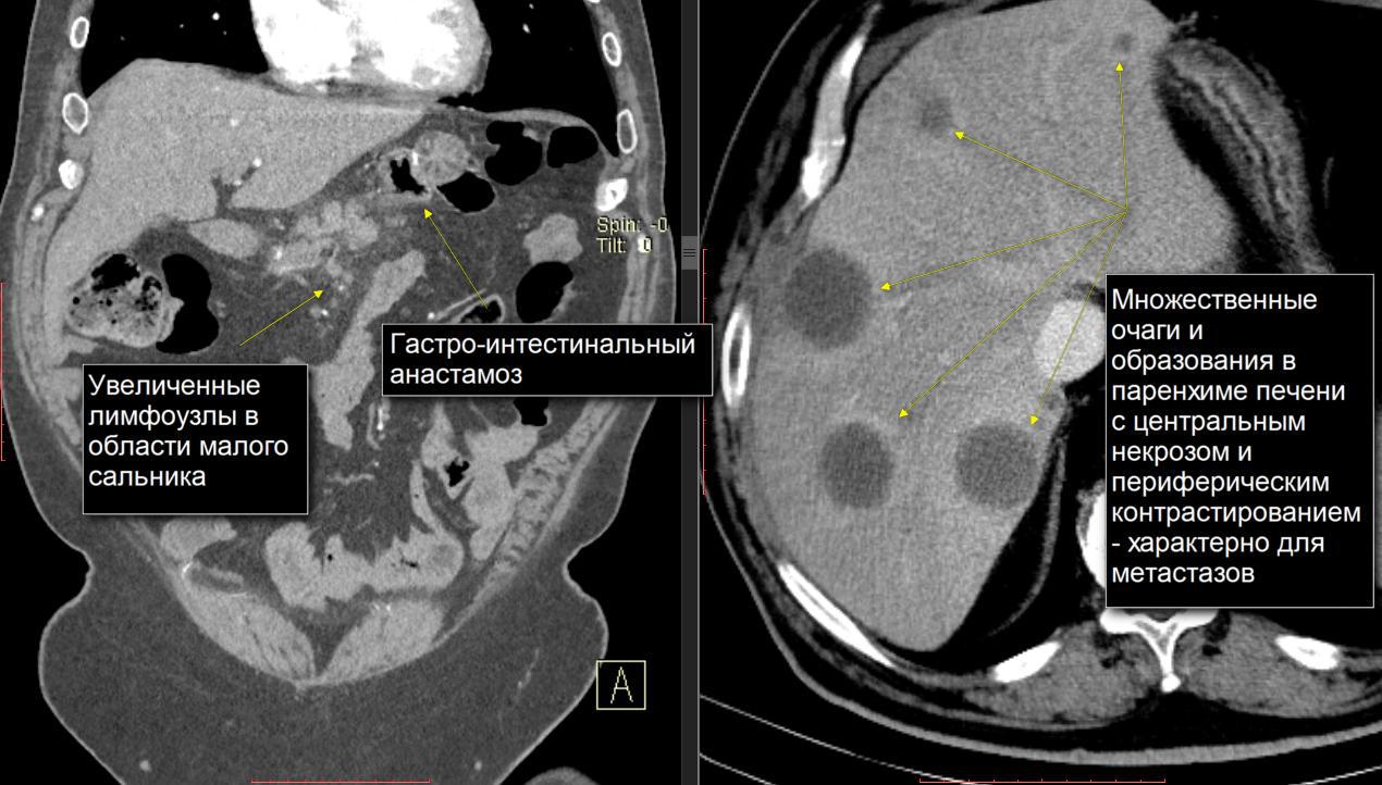 Кт Печени Фото