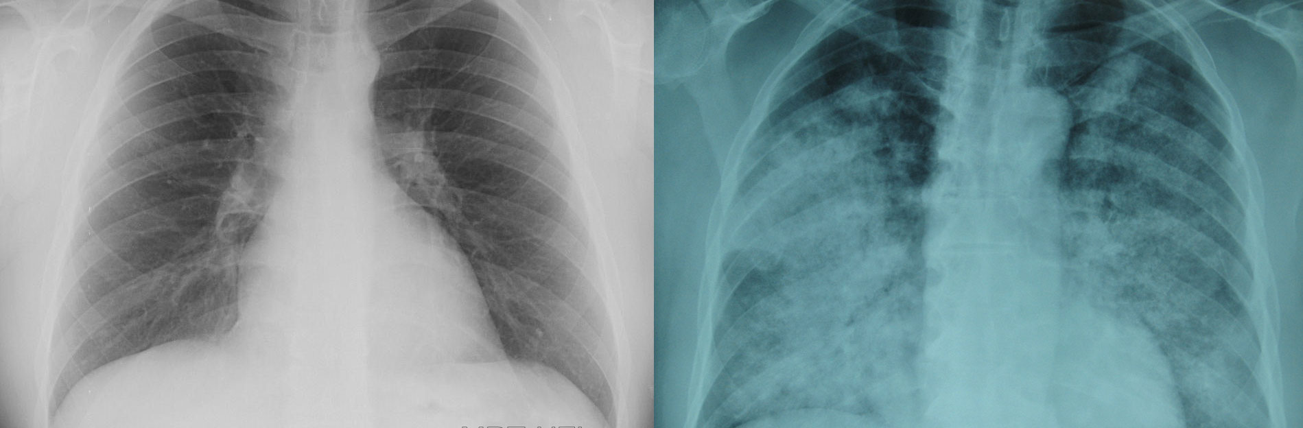 Сравнение снимков рентгена здоровых легких и зараженных пневмонией