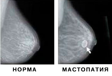 Сравнение снимков маммографии - норма и мастопатия