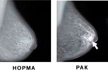 Сравнение снимков маммографии - норма и рак