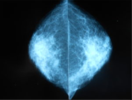 Здоровая молочная железа на маммографии в прямой проекции