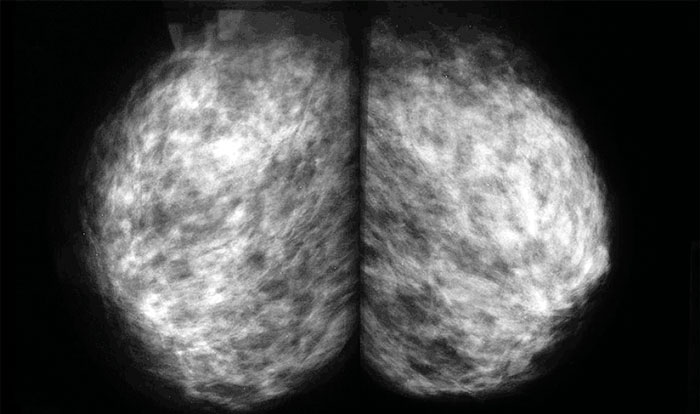 Маммография фкм. Фиброзно кистозная мастопатия маммограмма. Фиброзно-кистозная мастопатия молочных желез на маммографии. Маммография фиброзно кистозная мастопатия снимки. Фиброзная мастопатия на маммографии.