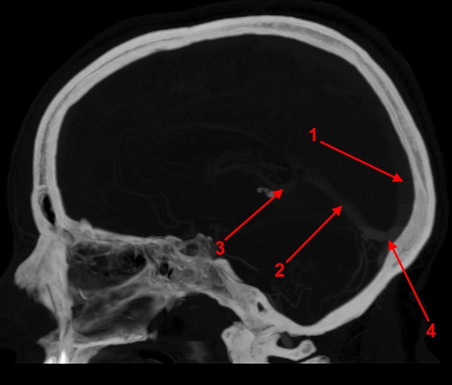 Кт синусов. Тромбоз сигмовидного синуса на кт. Тромбоз кавернозного синуса кт. Тромбоз Вена Галена кт. Тромбоз пещеристого синуса кт.