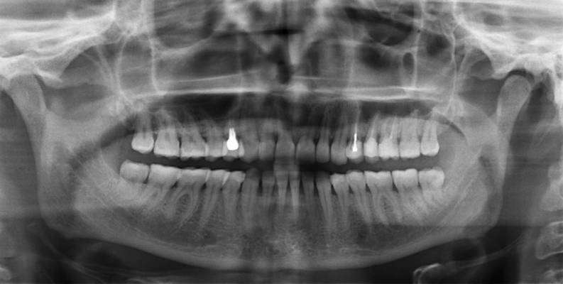 Как расшифровать рентгеновский снимок зубов