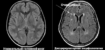 Сравнение снимка МРТ в норме и при энцефалопатии