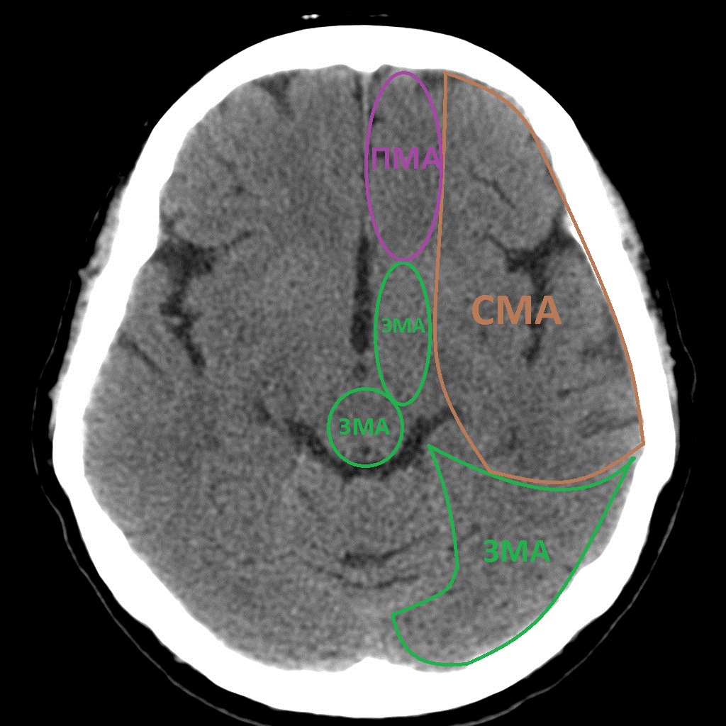 Терминология, используемая при описании КТ головного мозга в норме и при  патологии | Второе мнение