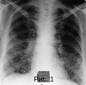 Патология легочного рисунка в рентгенологическом и кт изображении