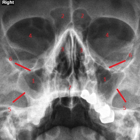 Пазухи носа на рентгенограмме