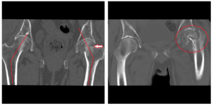 Перелом шейки бедренной кости на кт. Перелом головки бедренной кости кт. Перелом шейки бедра мрт. Метастаз головки бедренной кости кт.