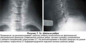 «Шейный остеохондроз» — дегенеративные изменения шейного отдела позвоночника