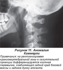 Клиновидные позвонки (полупозвонки)