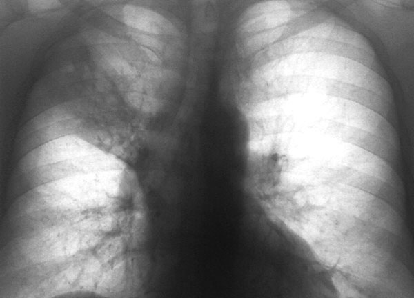 Абсцедирующая пневмония на рентген снимке