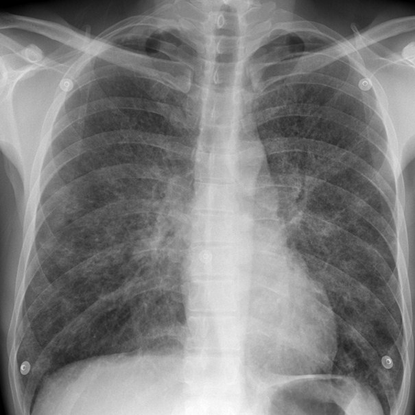 Пневмоцистная пневмония на снимке рентгена