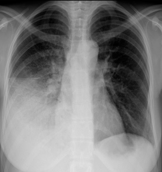 Правосторонняя нижнедолевая пневмония на снимке рентгена