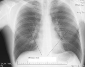 Рентгенограмма грудной клетки: легочные поля