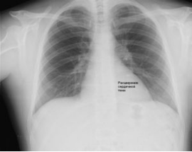 Расширение сердечной тени влево на рентгенограмме