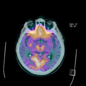 Пониженное накопление РФП - признак болезни Альцгеймера