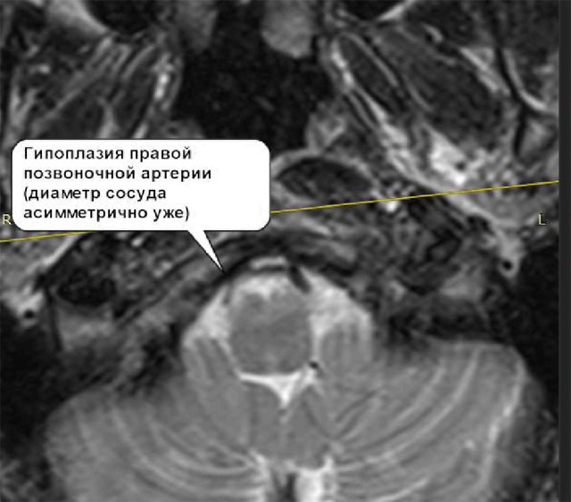 Подвывихи головки лучевой кости - Травмы; отравления - Справочник MSD Профессиональная версия