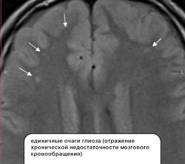 Ротационный подвывих C1