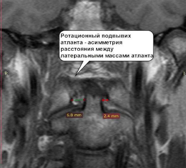 Подвывих шейного позвонка у взрослых и детей: симптомы и лечение | Клиника Temed
