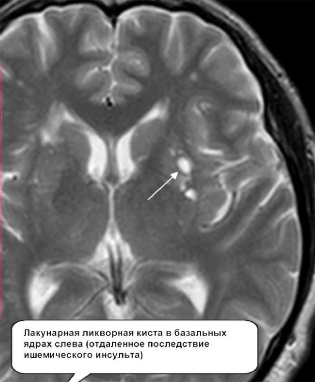 Ликворная киста головного
