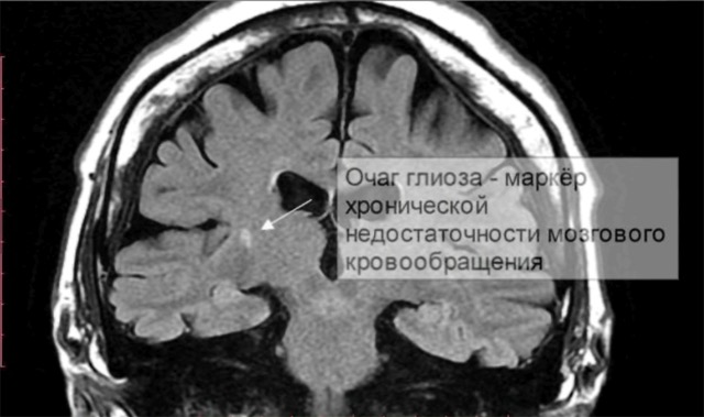 Реконверсия костного мозга на мрт что это. Мр картина единичных супратенториальных очагов глиоза что это. мр-картина микроангиопатии головного мозга. очаги глиоза на мрт. очаги микроангиопатии головного мозга что это такое.