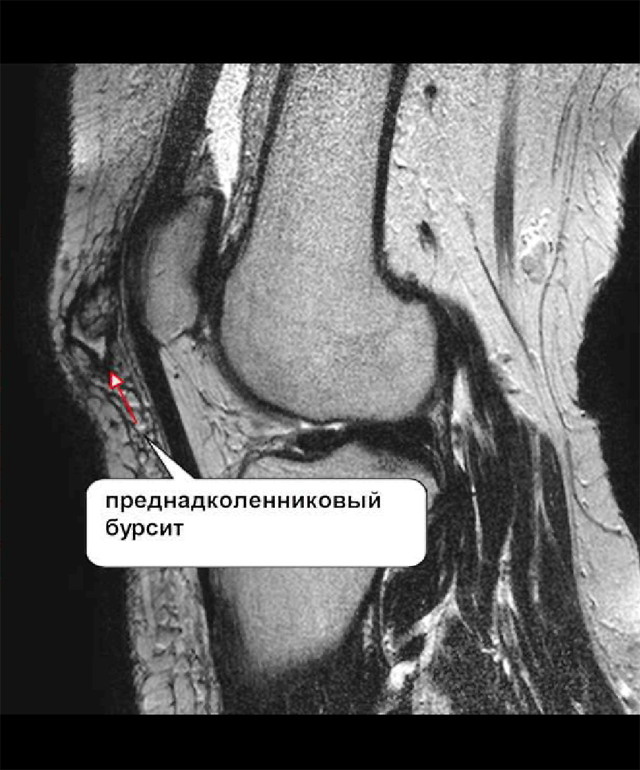 Бурсит коленного сустава мрт. Отёк костного мозга бедренной кости мрт. Трабекулярный отёк на мрт. Трабекулярный отек бедренной кости.